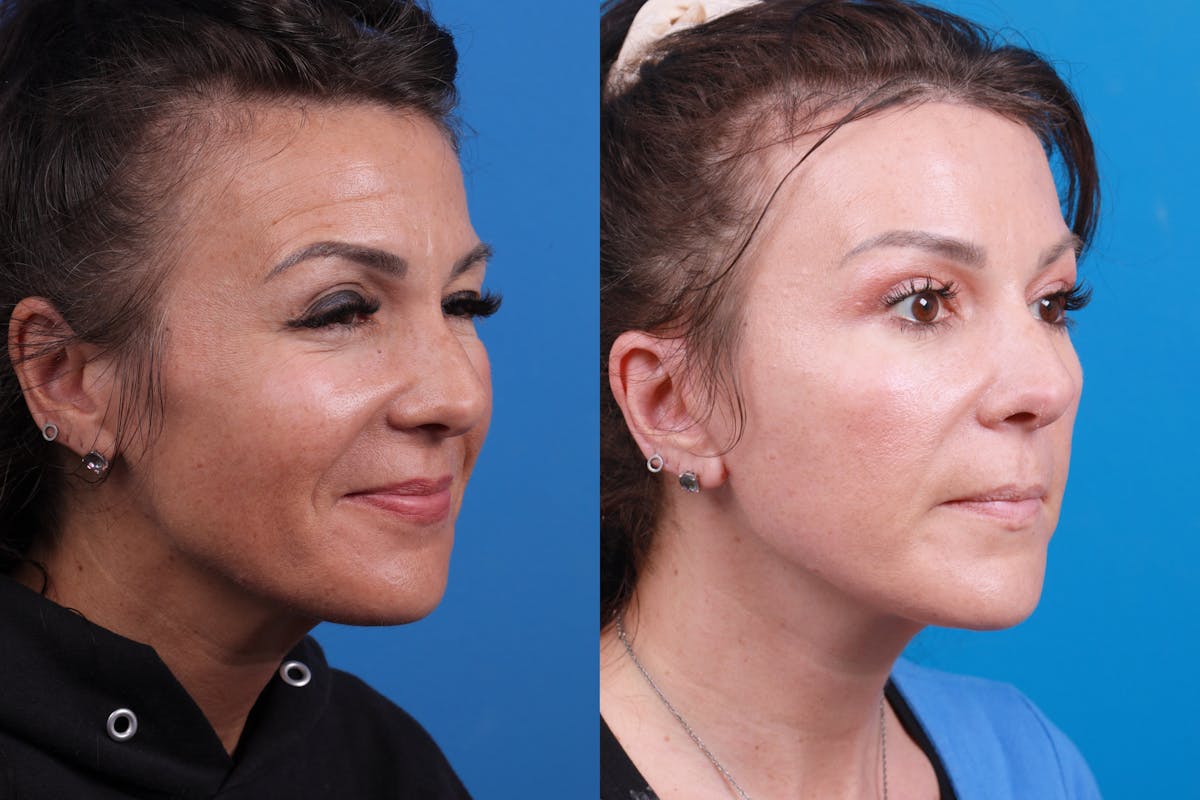 Eyelid Surgery Before & After Gallery - Patient 146900097 - Image 4