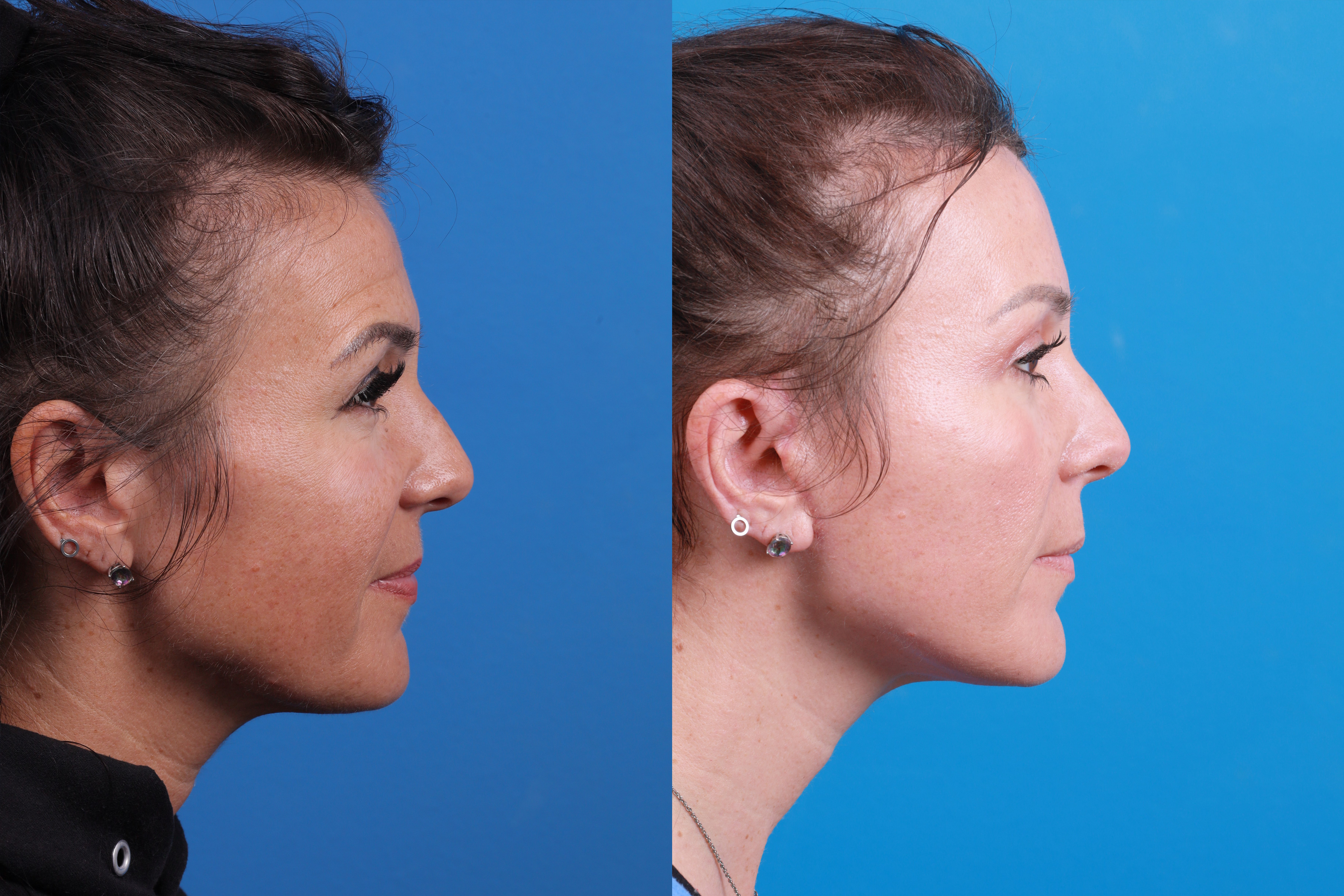 Eyelid Surgery Before & After Gallery - Patient 159212 - Image 5