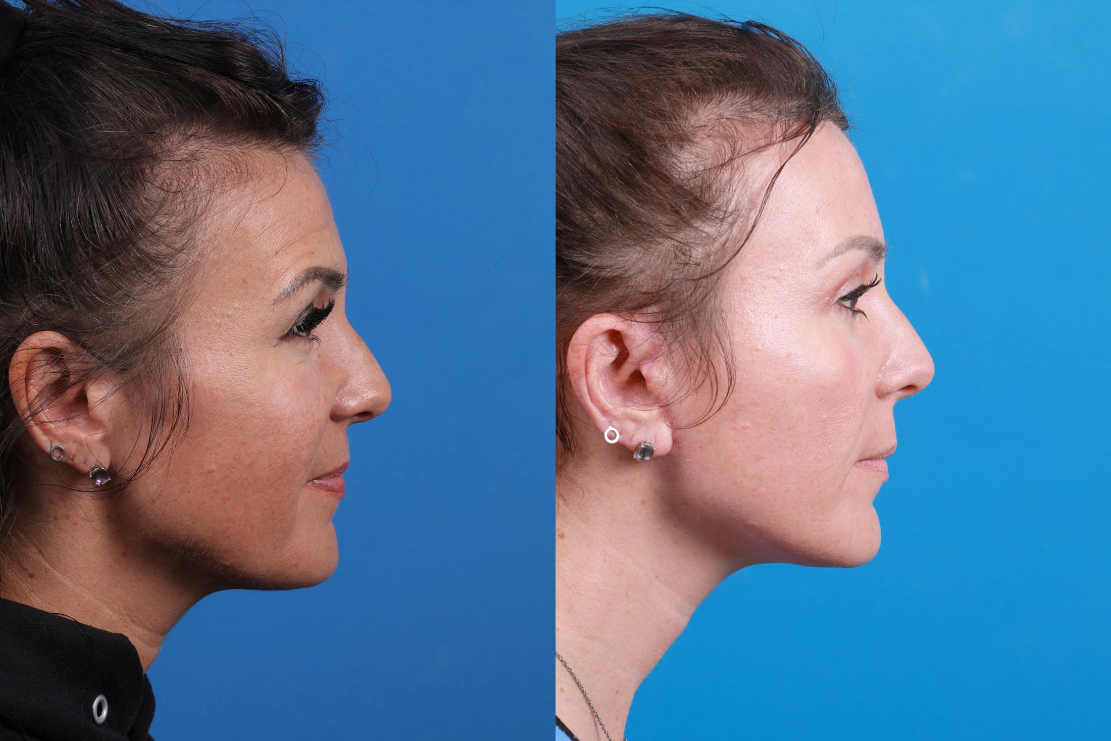 Brow Lift Before & After Gallery - Patient 146900099 - Image 5