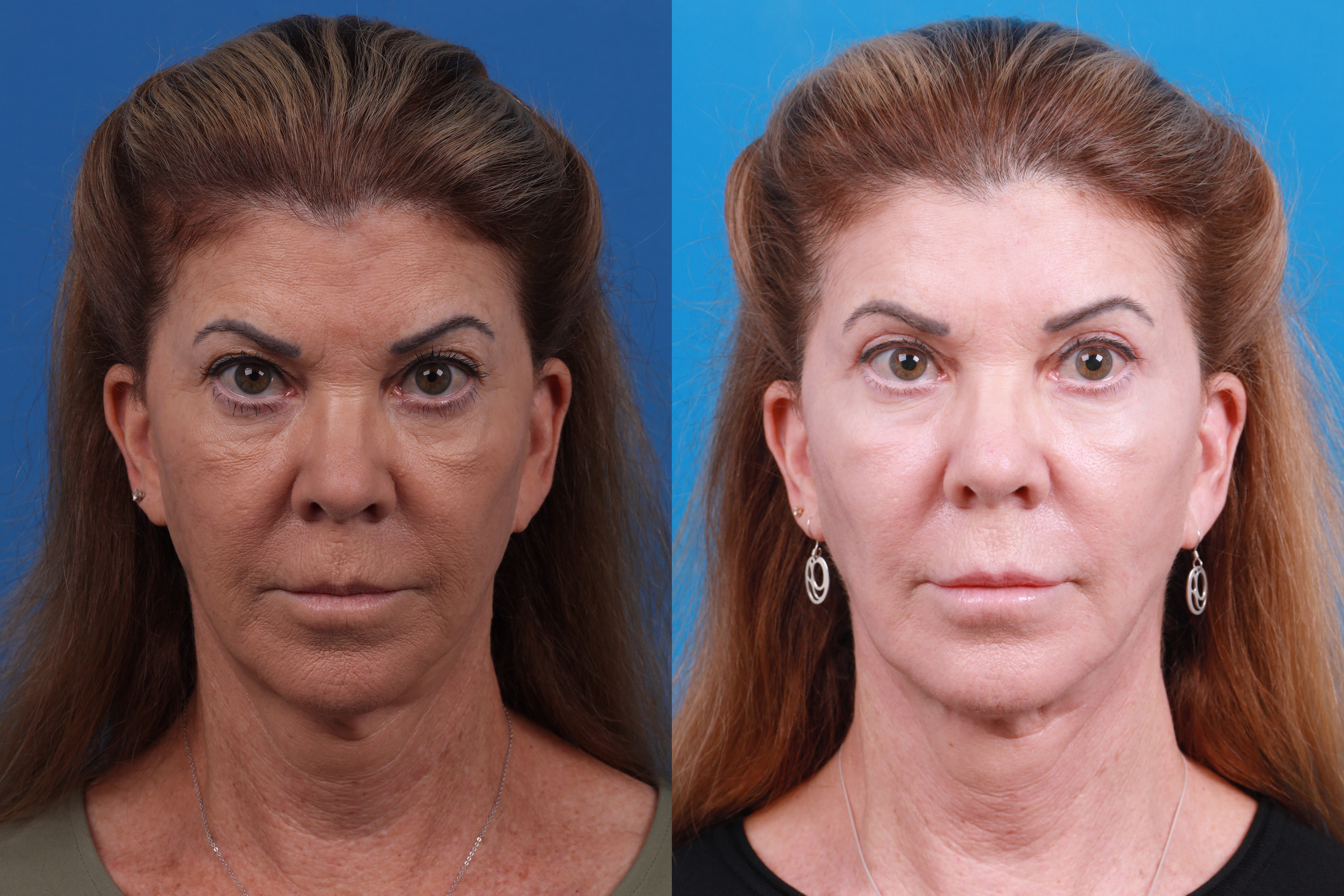 Express Lift Before & After Gallery - Patient 106553 - Image 1