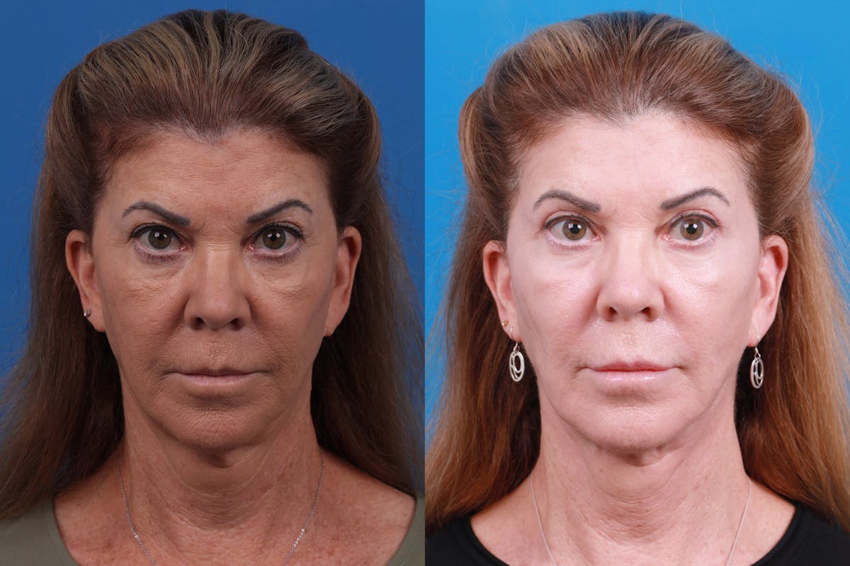 Skin Resurfacing Before & After Gallery - Patient 146900360 - Image 1