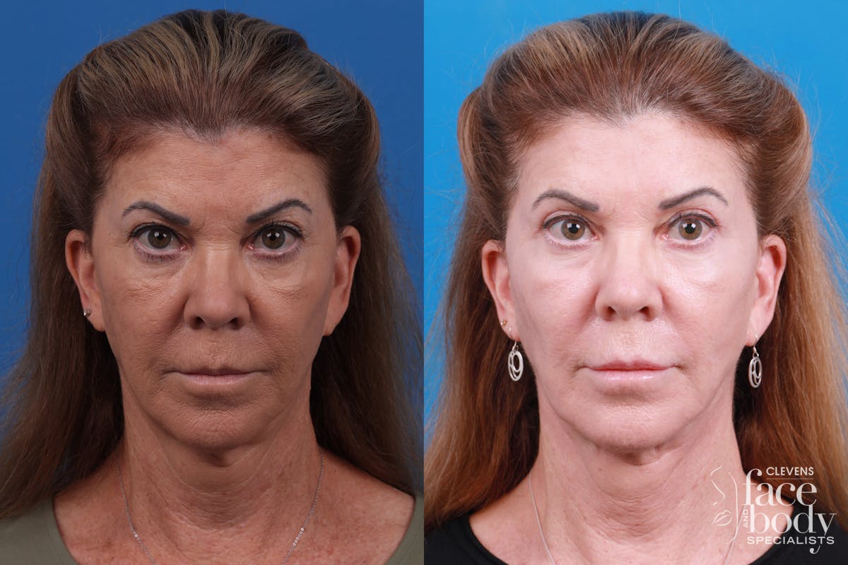 Skin Resurfacing Before & After Gallery - Patient 146900360 - Image 1