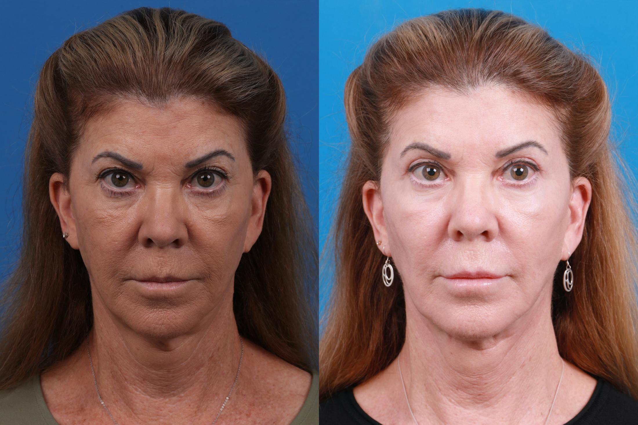 Eyelid Surgery Before & After Gallery - Patient 146900303 - Image 1