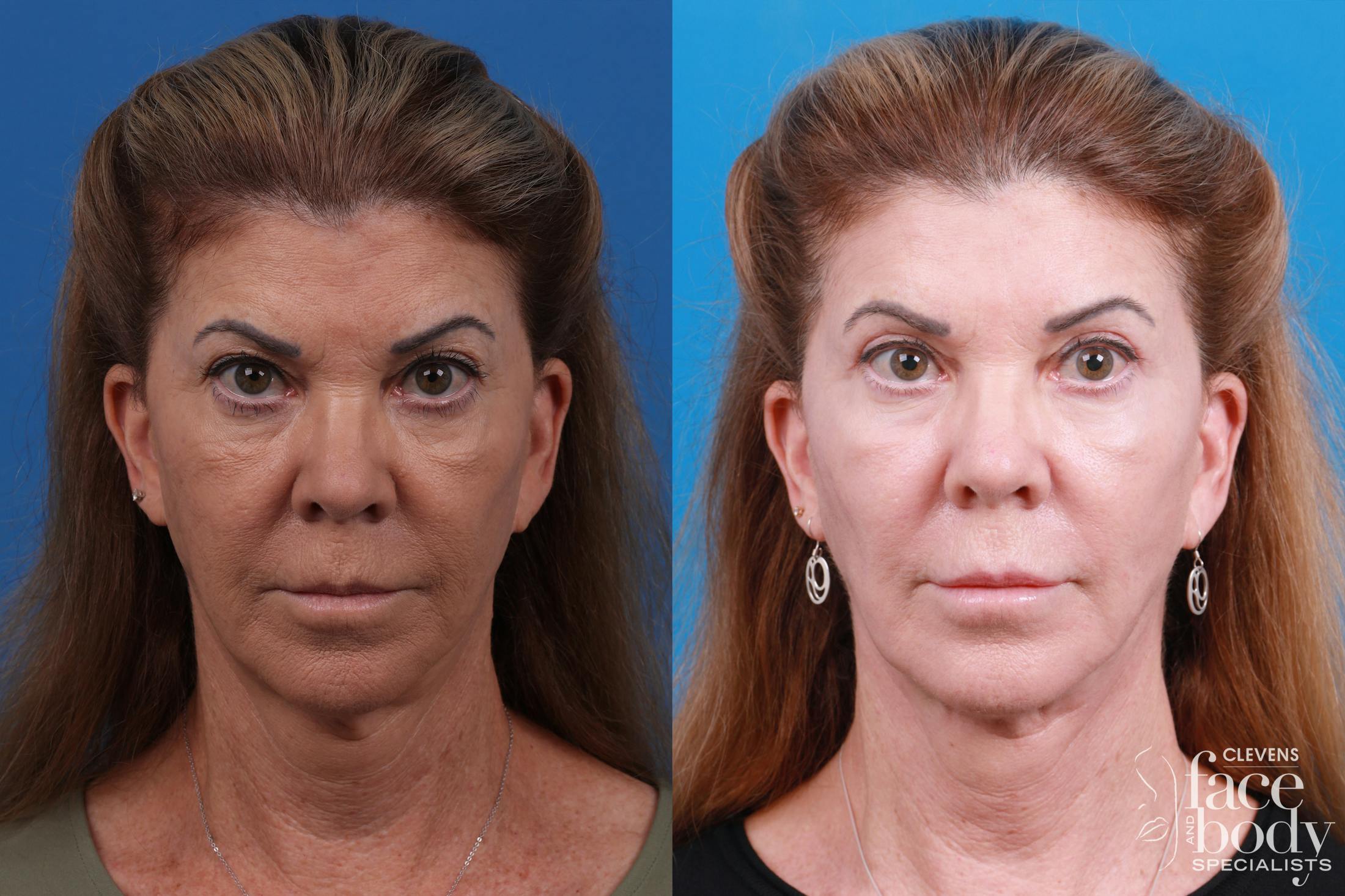 Skin Resurfacing Before & After Gallery - Patient 146900360 - Image 1