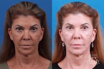 Eyelid Surgery Before & After Gallery - Patient 410220 - Image 1