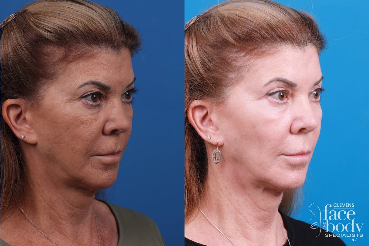 Skin Resurfacing Before & After Gallery - Patient 146900360 - Image 2