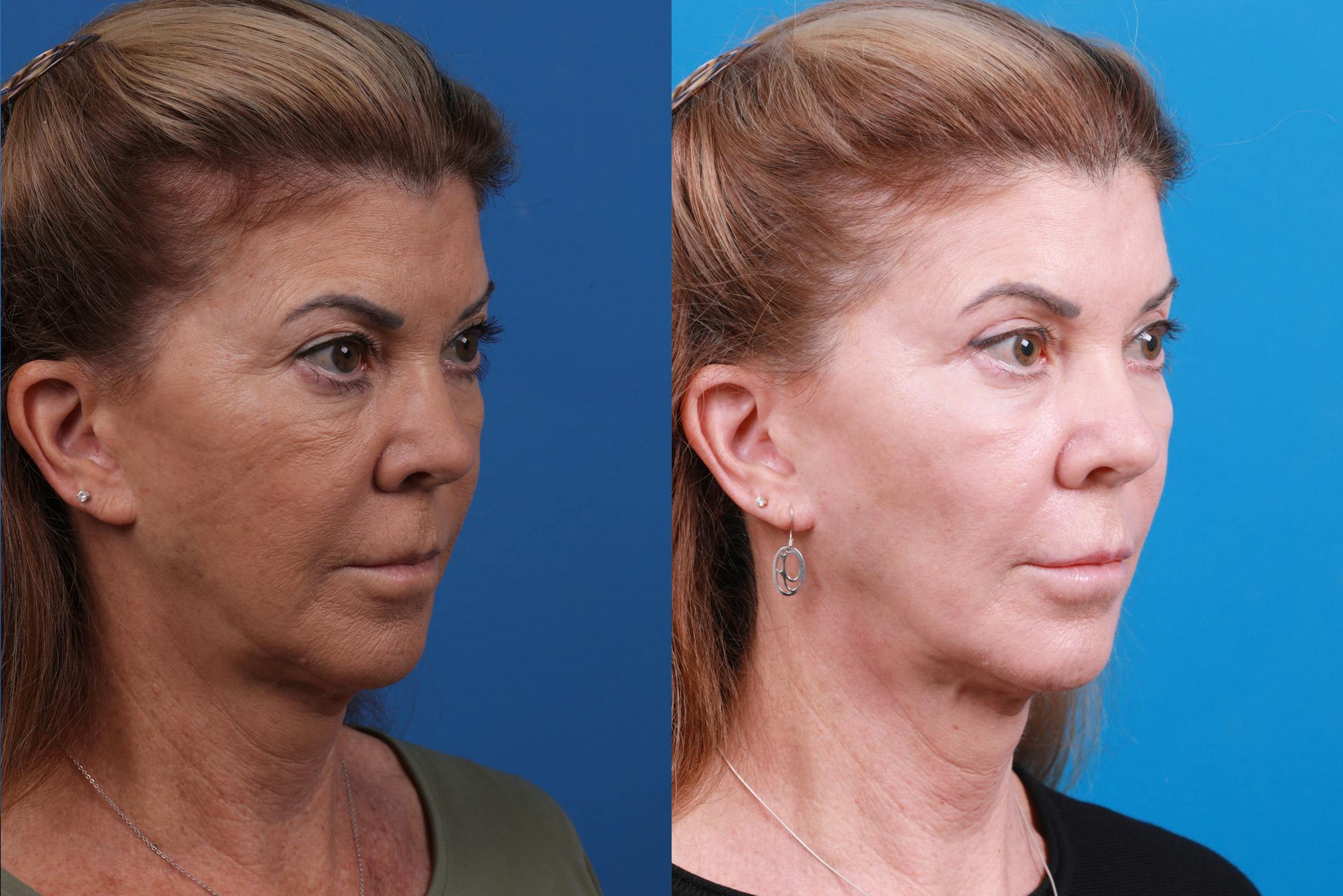Skin Resurfacing Before & After Gallery - Patient 146900360 - Image 2
