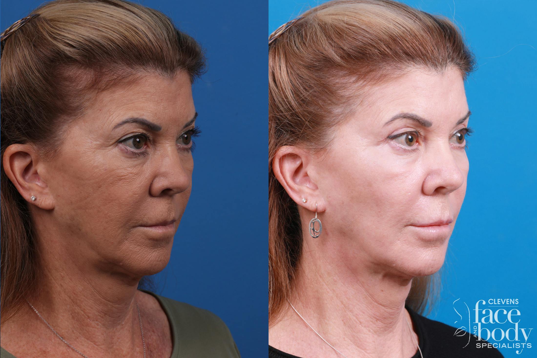 Skin Resurfacing Before & After Gallery - Patient 146900360 - Image 2