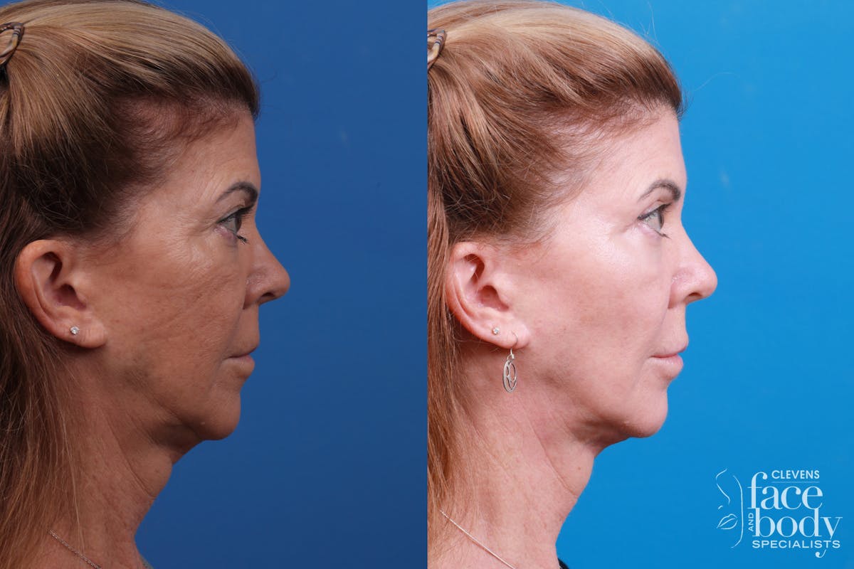 Skin Resurfacing Before & After Gallery - Patient 146900360 - Image 3