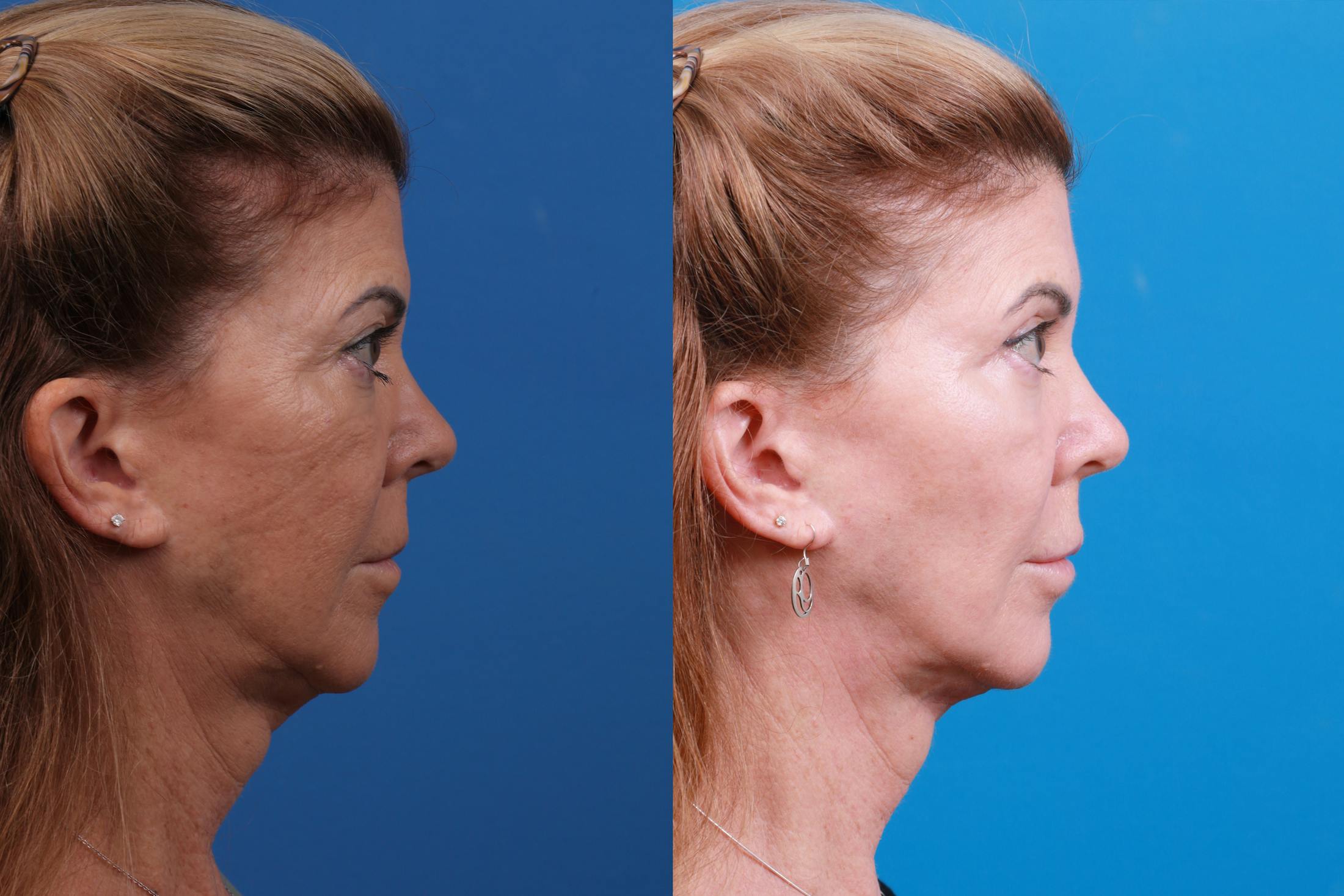 Express Lift Before & After Gallery - Patient 146900279 - Image 3