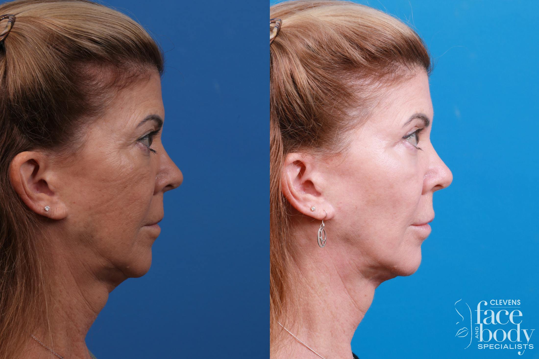 Skin Resurfacing Before & After Gallery - Patient 146900360 - Image 3