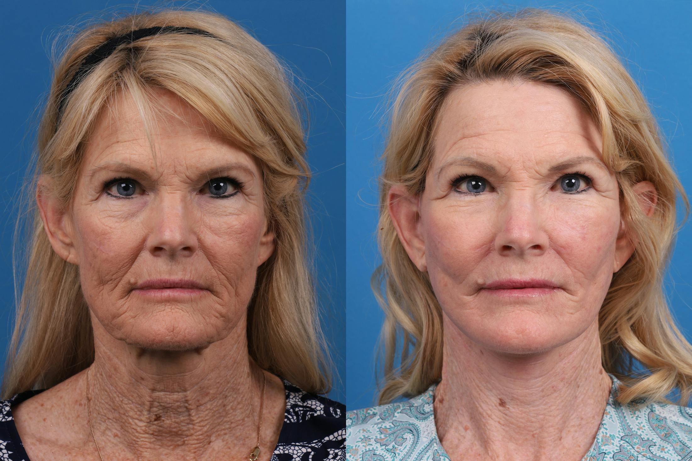 Facelift Before & After Gallery - Patient 146900394 - Image 1