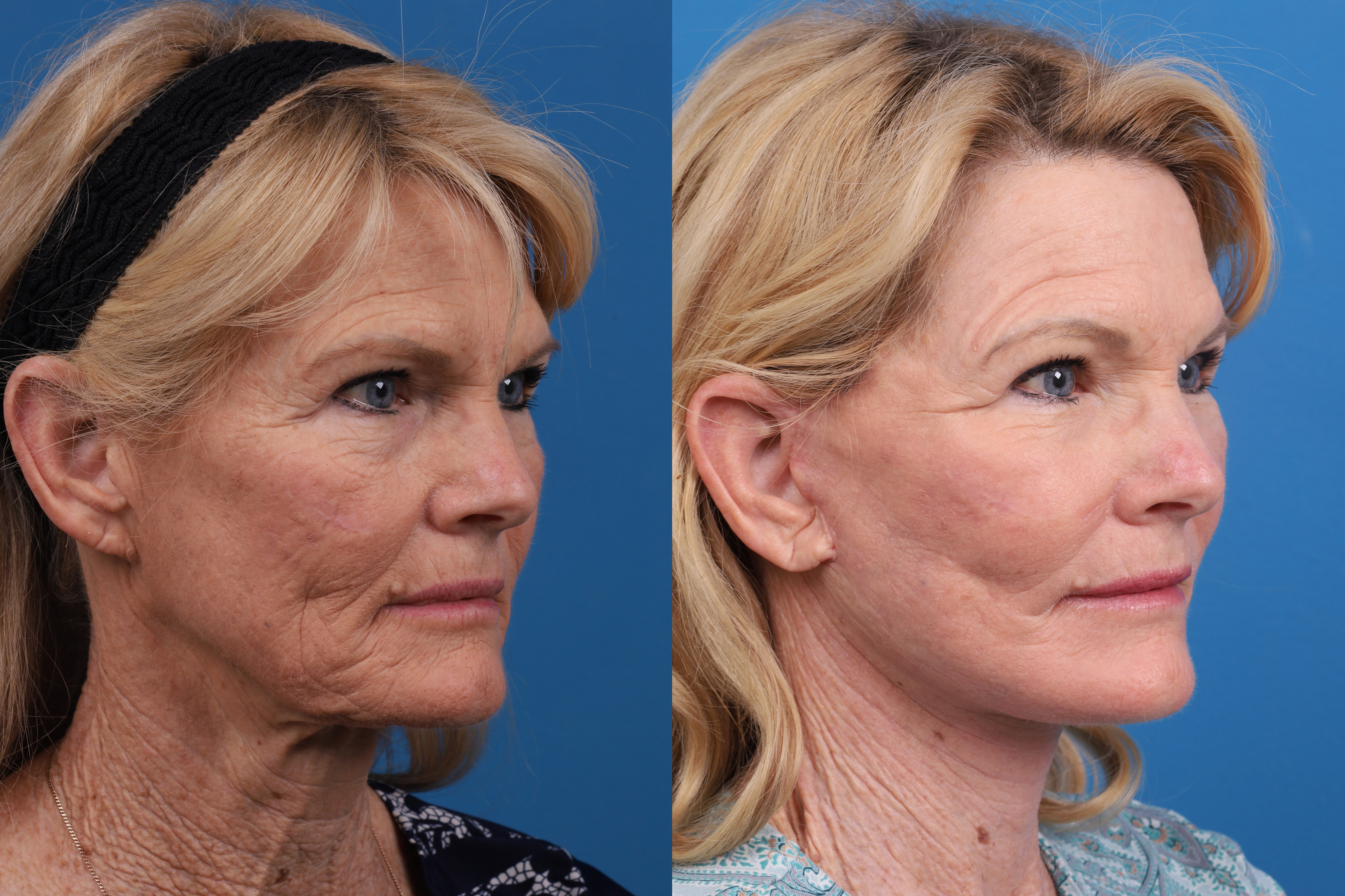 Skin Resurfacing Before & After Gallery - Patient 146900399 - Image 2