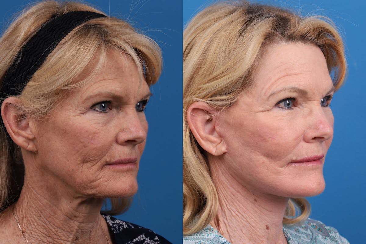 Facelift Before & After Gallery - Patient 146900394 - Image 2