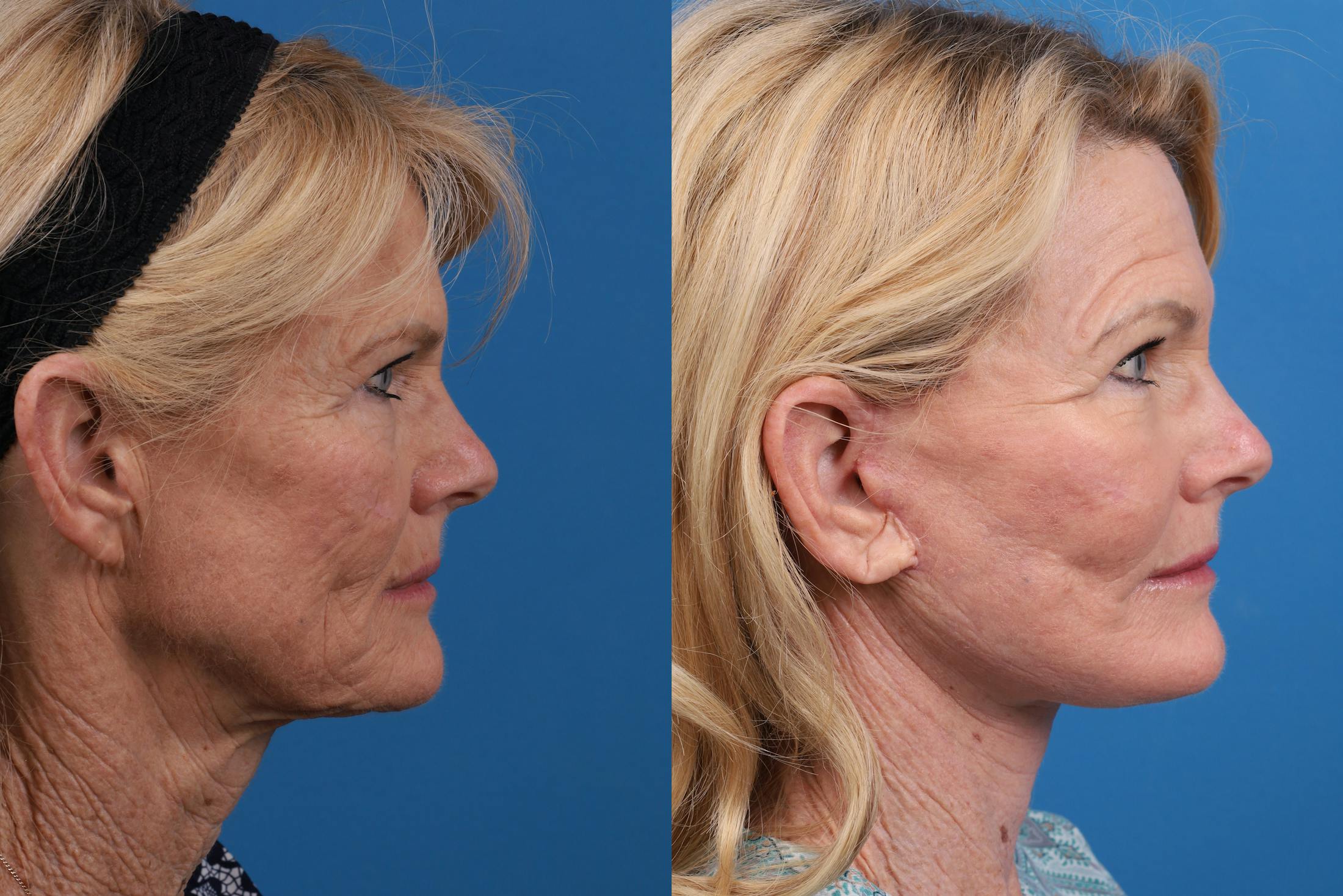 Skin Resurfacing Before & After Gallery - Patient 146900399 - Image 3