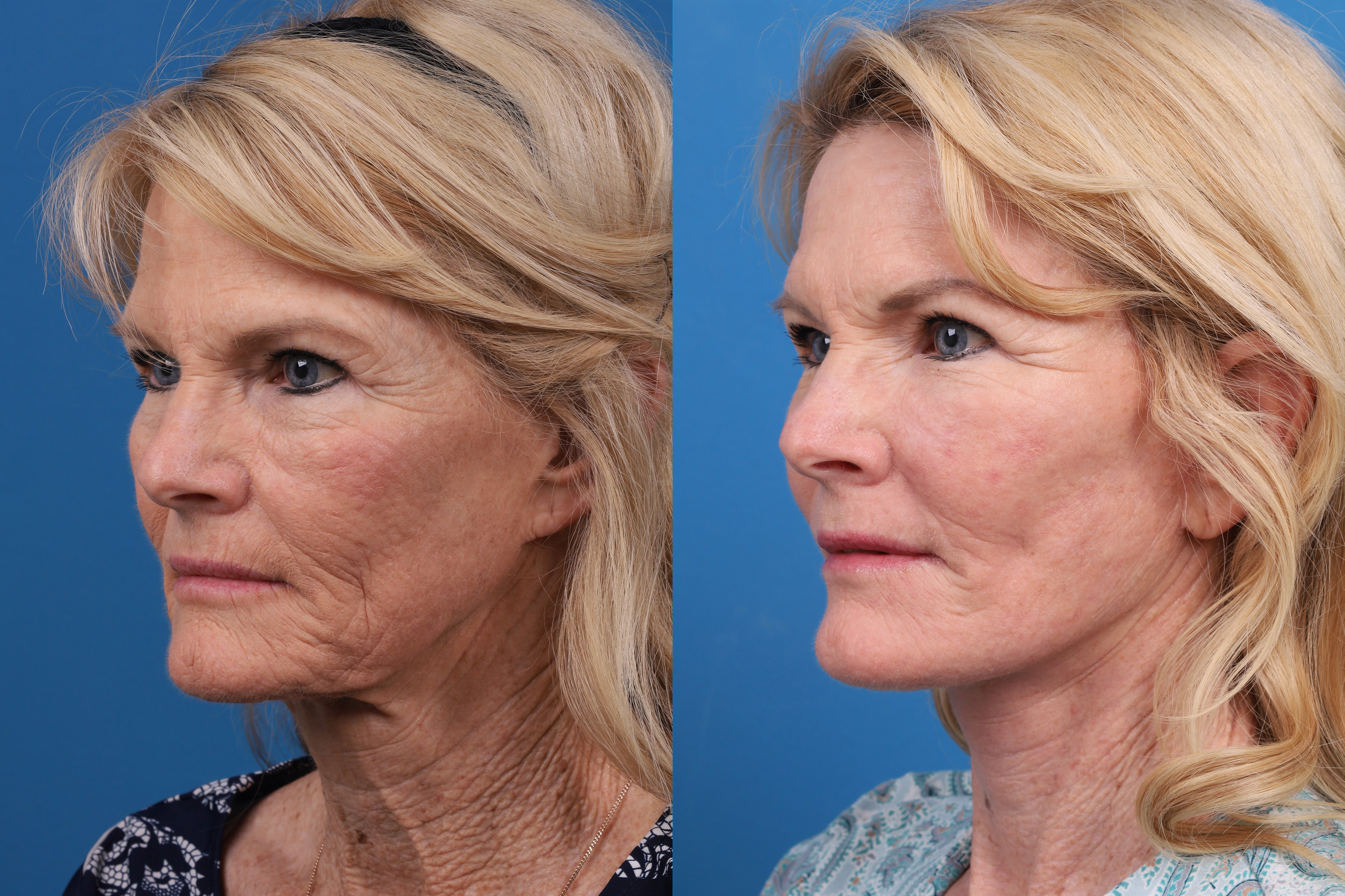 Skin Resurfacing Before & After Gallery - Patient 146900399 - Image 4