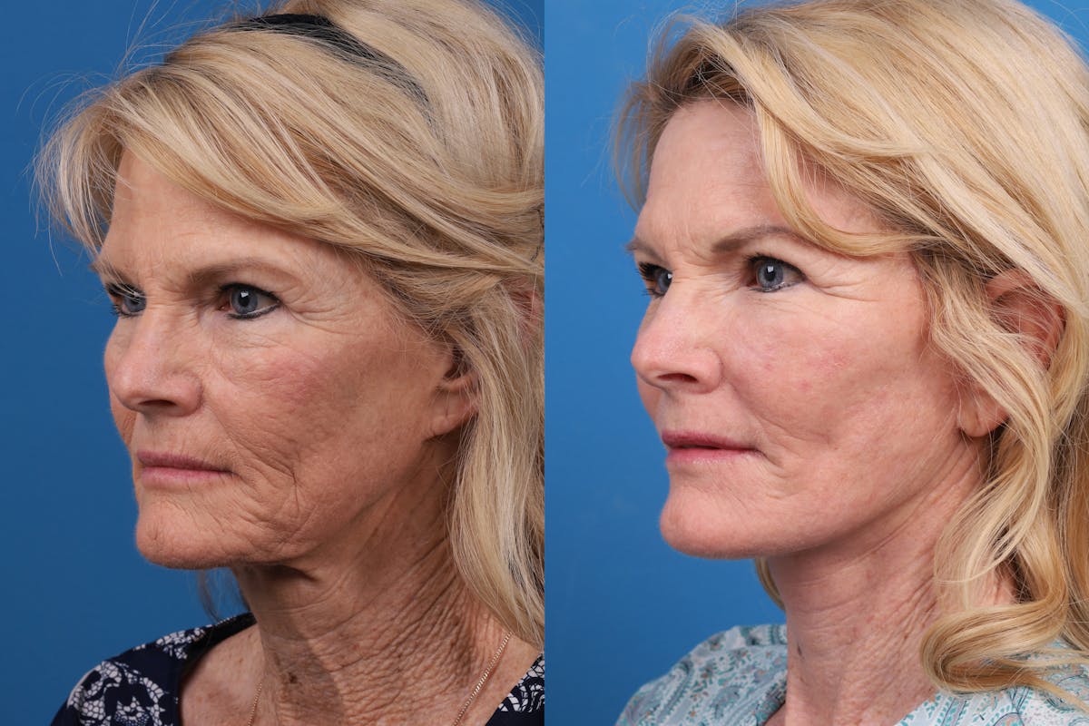 Facelift Before & After Gallery - Patient 146900394 - Image 4