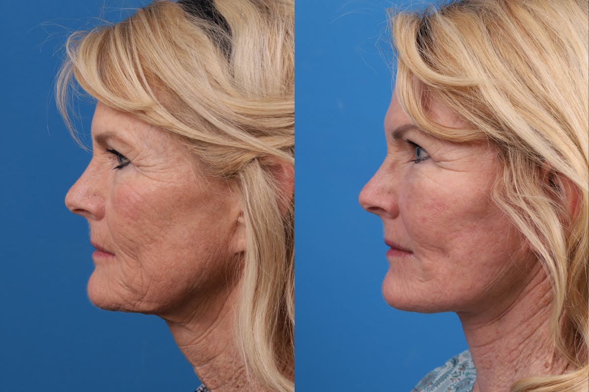 Facelift Before & After Gallery - Patient 146900394 - Image 5