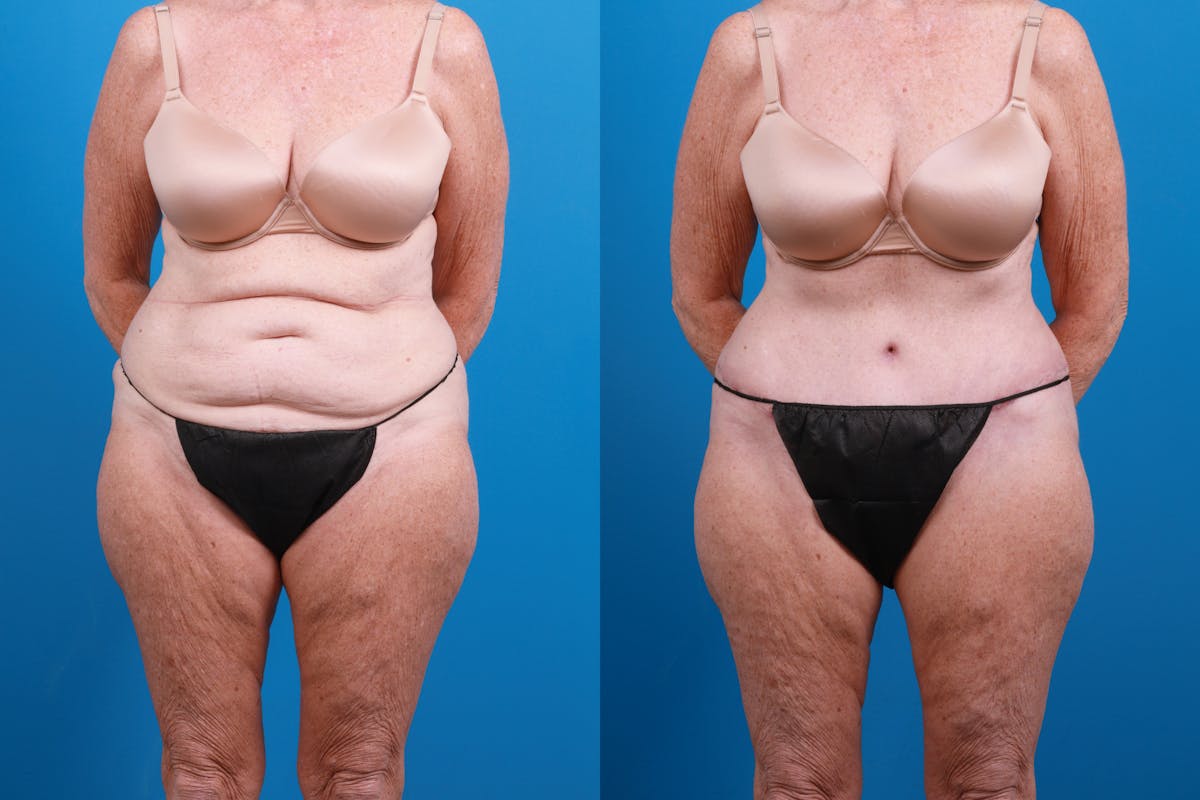 Tummy Tuck Before & After Gallery - Patient 714315 - Image 1