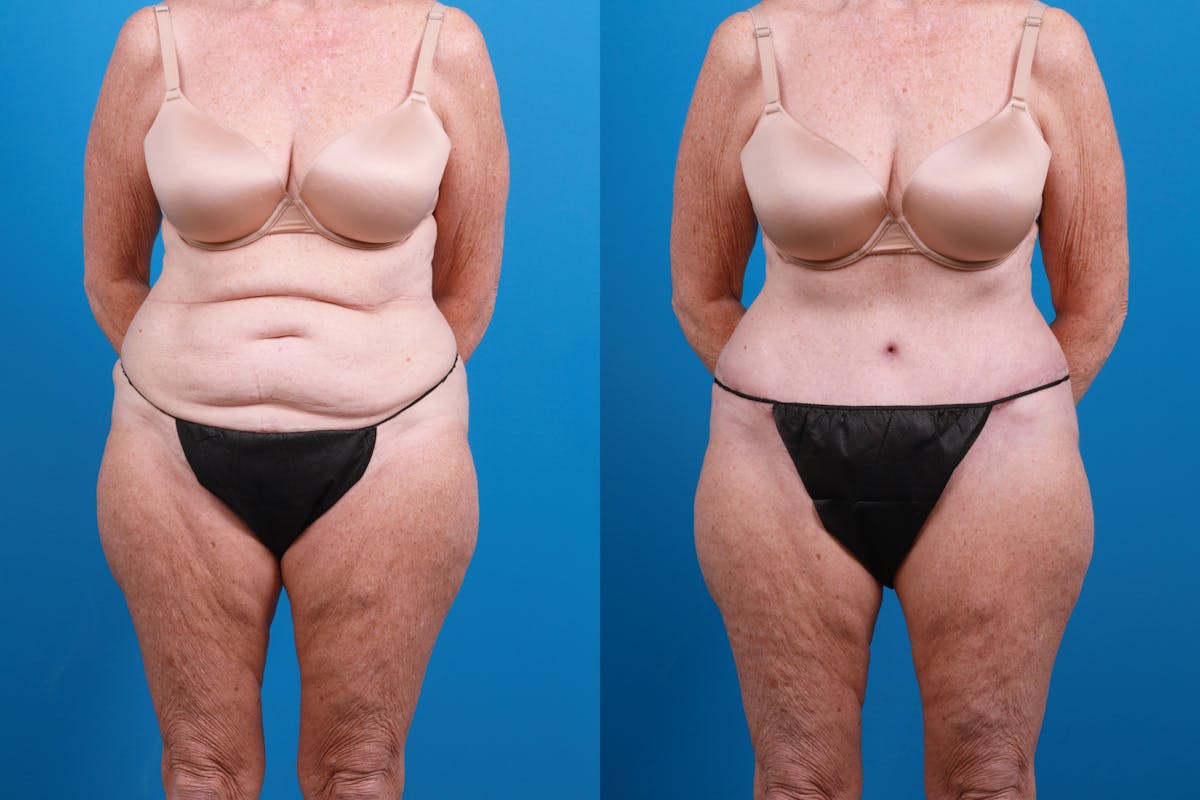 Tummy Tuck Before & After Gallery - Patient 300869 - Image 1