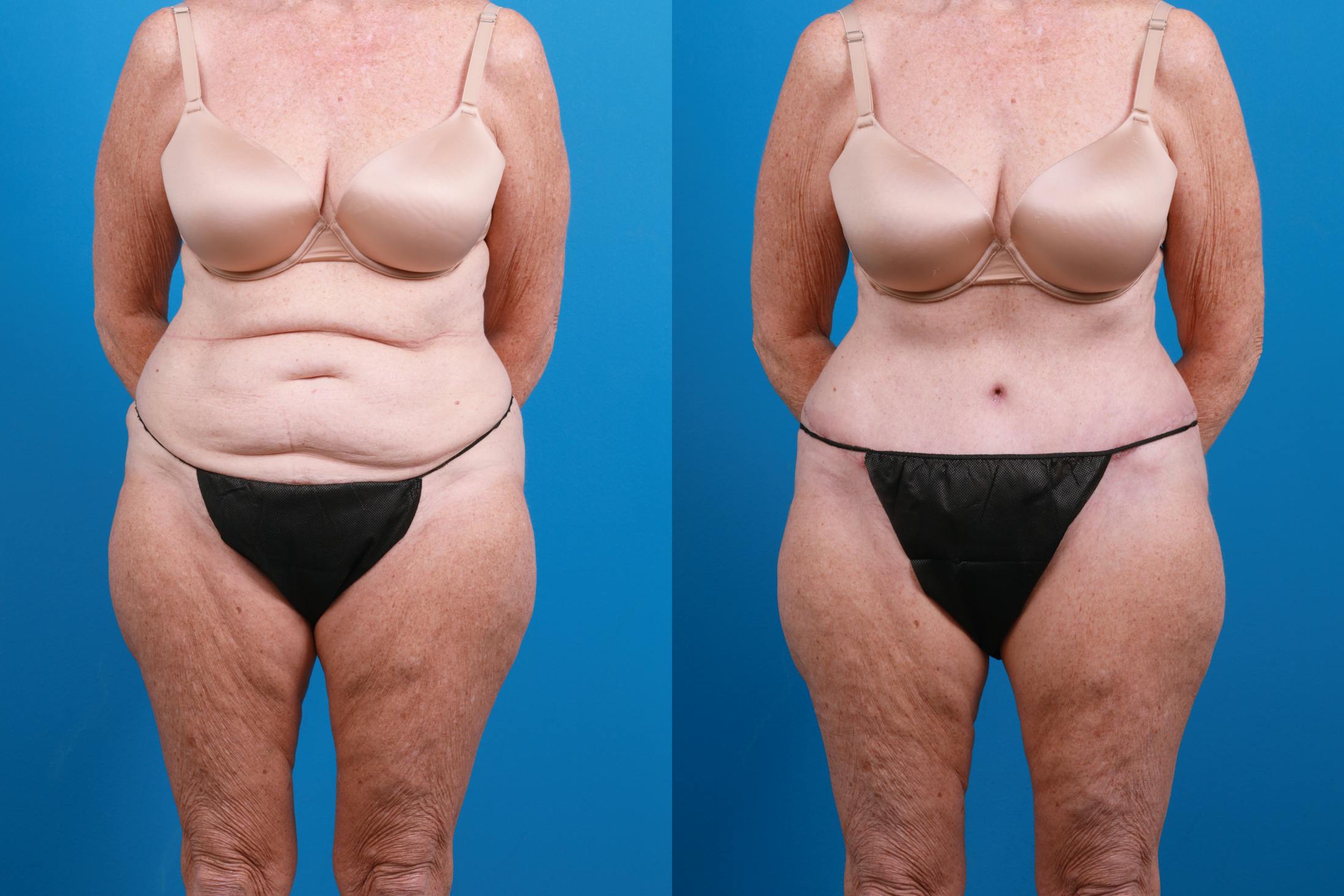 Tummy Tuck Before & After Gallery - Patient 146900423 - Image 1