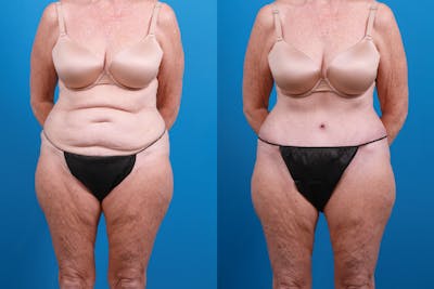 Tummy Tuck Before & After Gallery - Patient 714315 - Image 1