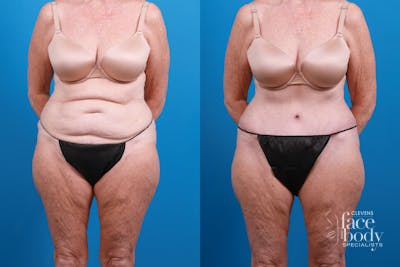 Hidden Tummy Tuck Before & After Gallery - Patient 444744 - Image 1