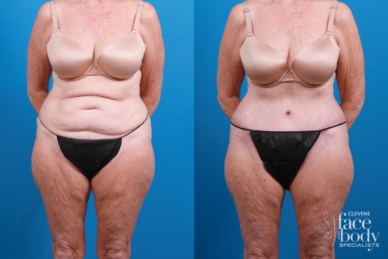 Hidden Tummy Tuck Before & After Gallery - Patient 444744 - Image 1