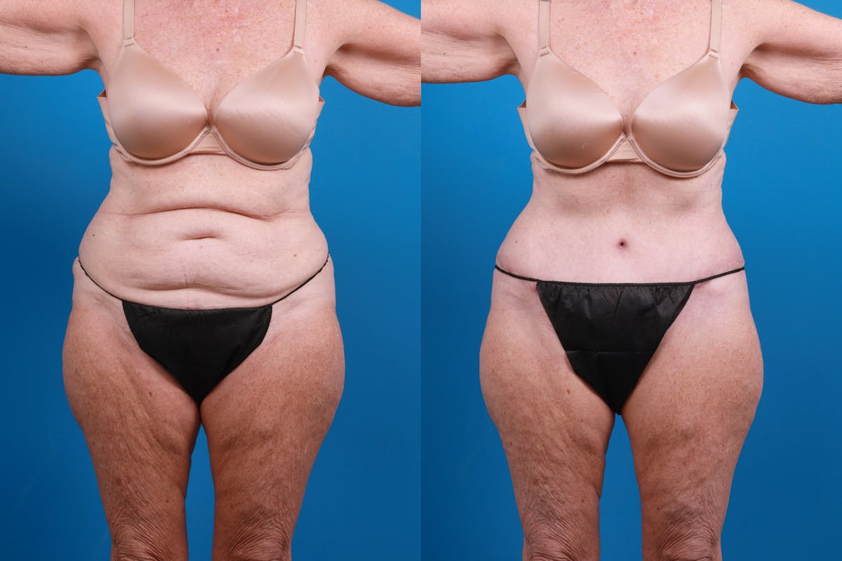 Tummy Tuck Before & After Gallery - Patient 300869 - Image 2