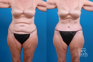 Hidden Tummy Tuck Before & After Gallery - Patient 444744 - Image 2