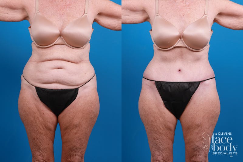 Hidden Tummy Tuck Before & After Gallery - Patient 444744 - Image 2