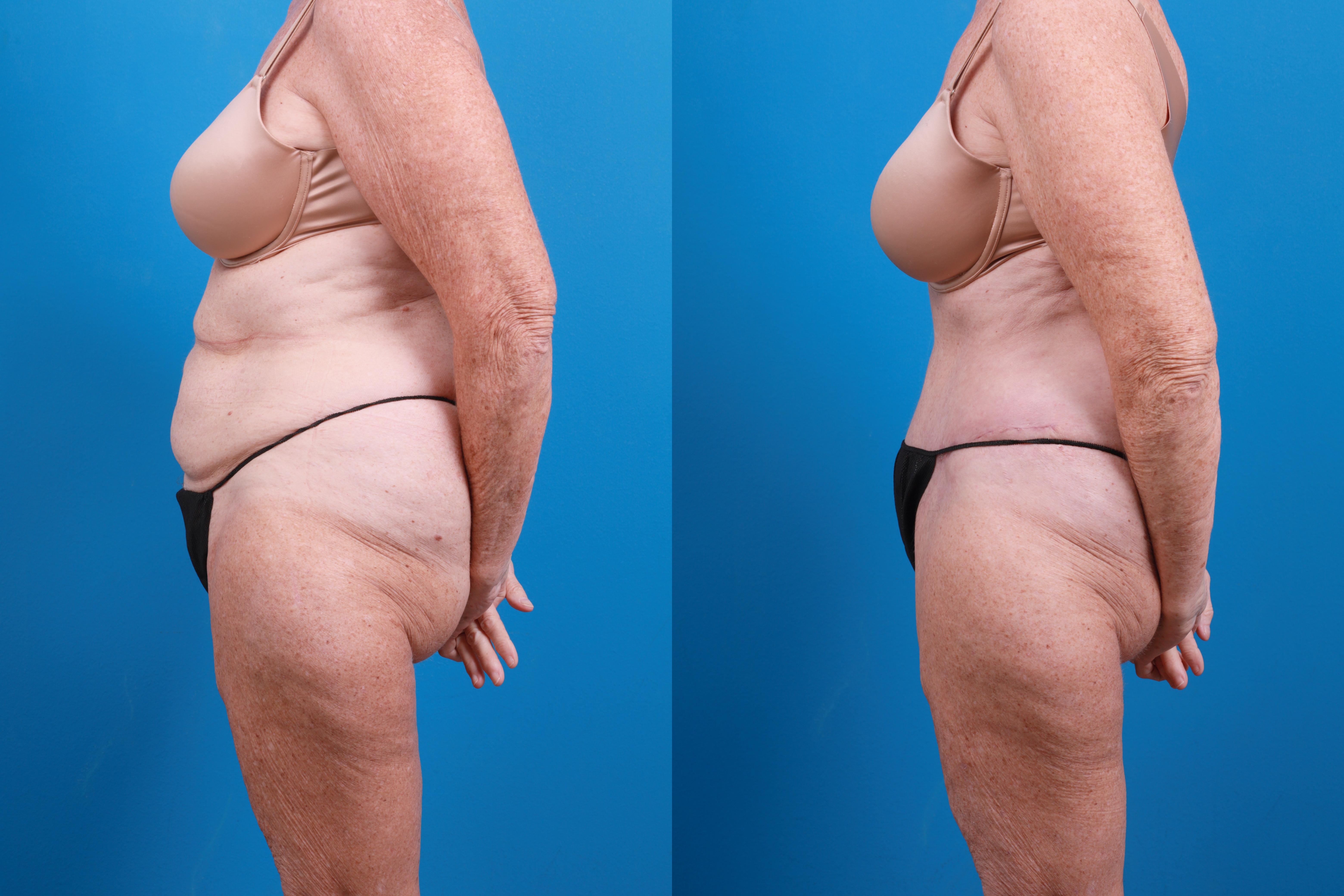 Hidden Tummy Tuck Before & After Gallery - Patient 444744 - Image 3