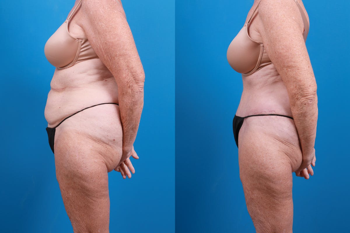 Tummy Tuck Before & After Gallery - Patient 714315 - Image 3