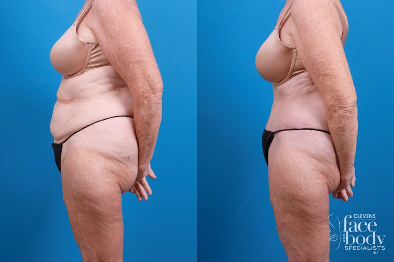 Hidden Tummy Tuck Before & After Gallery - Patient 444744 - Image 3