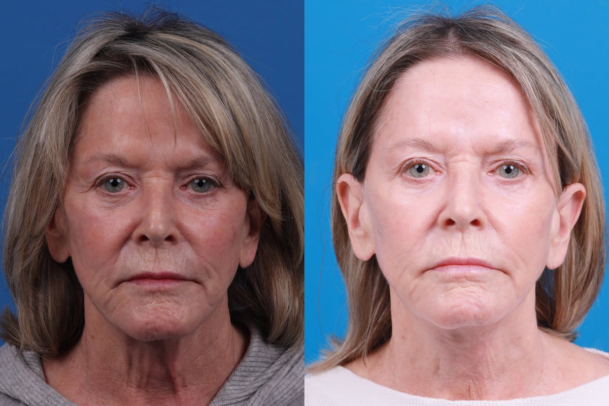 Profile Neck Lift Before & After Gallery - Patient 146900704 - Image 1