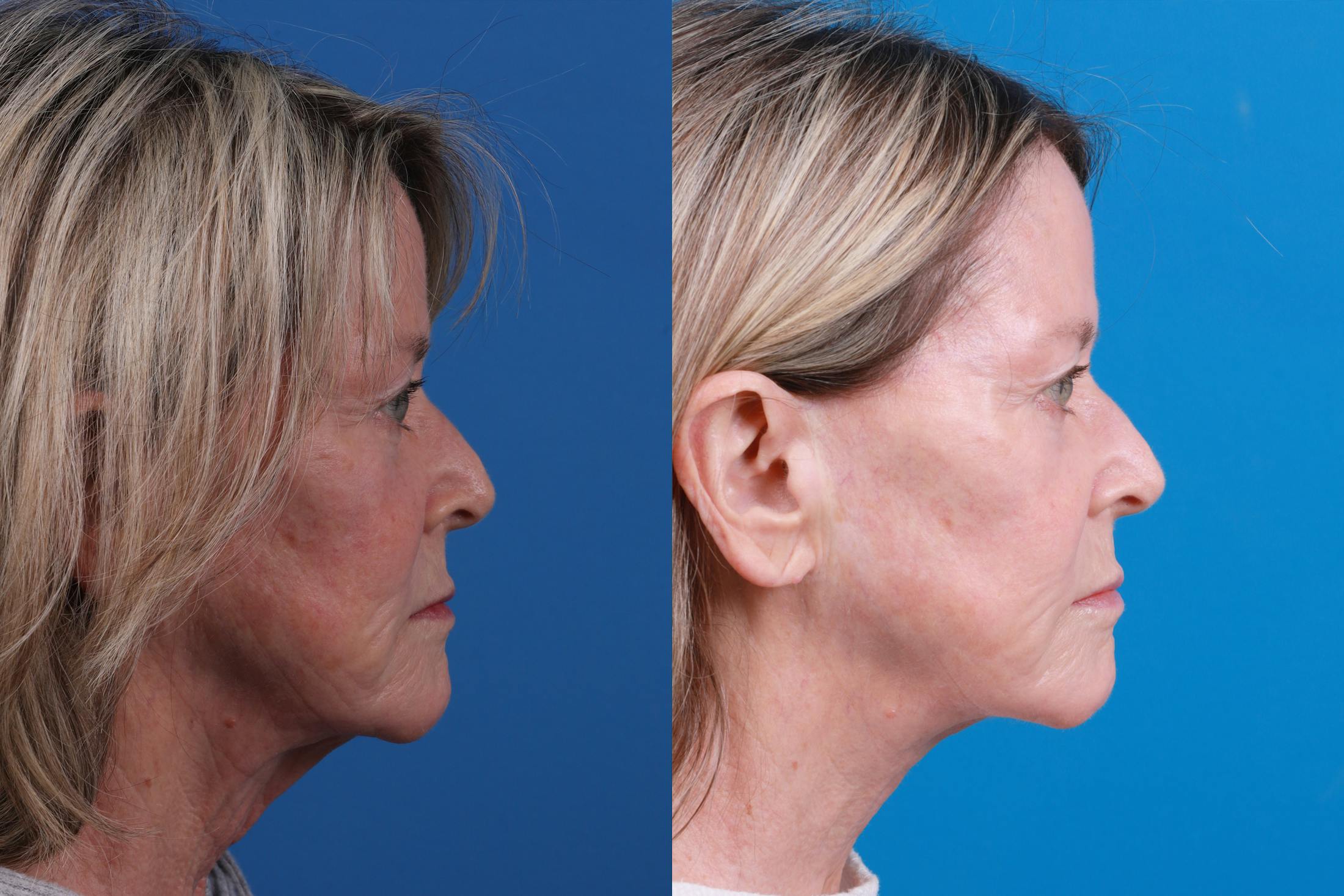 Profile Neck Lift Before & After Gallery - Patient 146900704 - Image 3