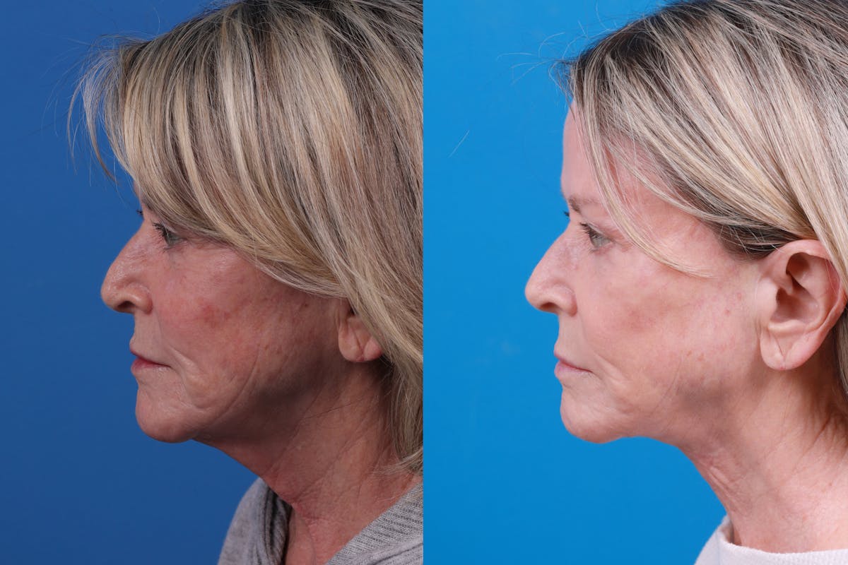 Profile Neck Lift Before & After Gallery - Patient 146900704 - Image 5