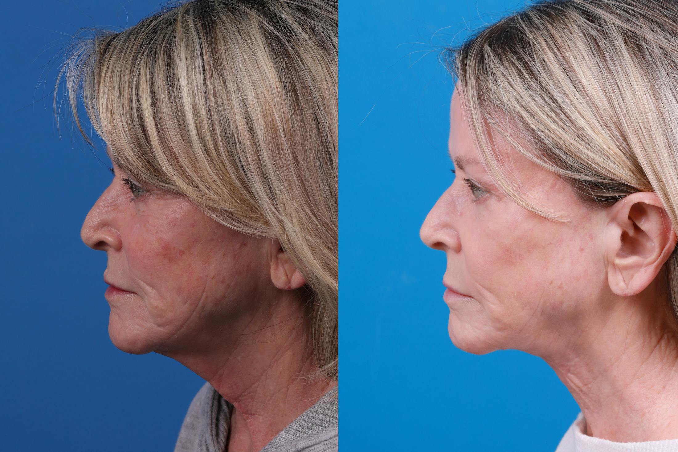 Profile Neck Lift Before & After Gallery - Patient 146900704 - Image 5