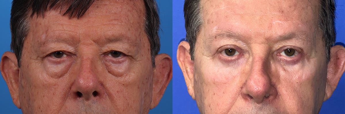 Eyelid Surgery Before & After Gallery - Patient 146900711 - Image 1