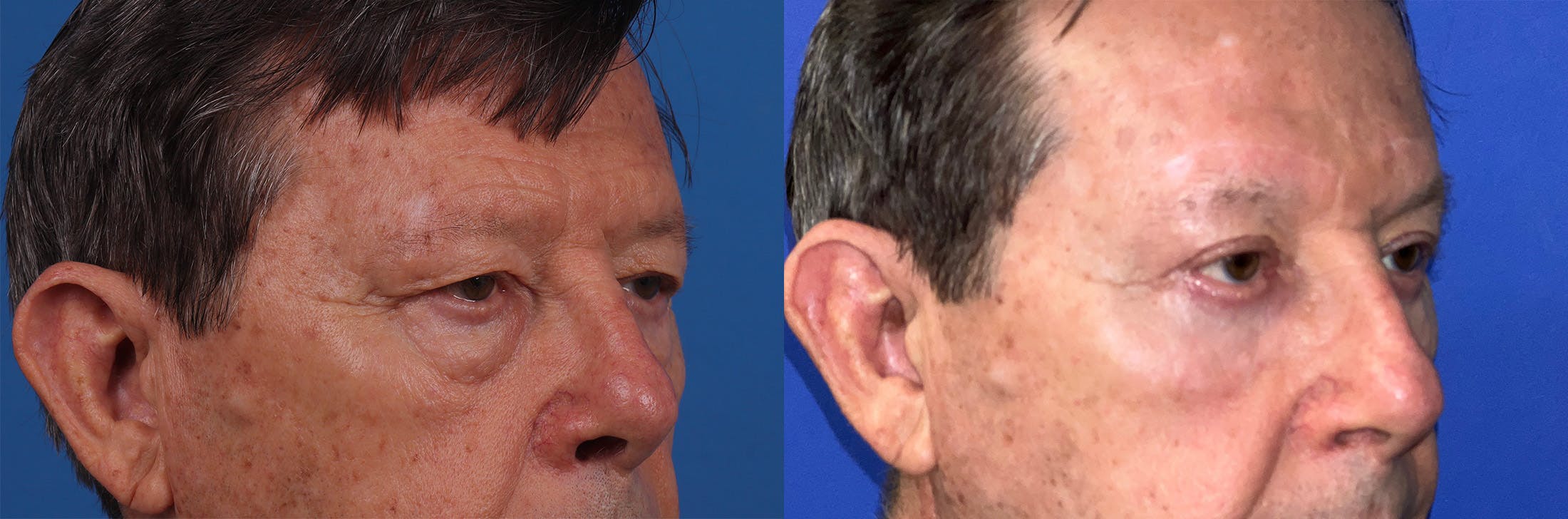 Eyelid Surgery Before & After Gallery - Patient 146900711 - Image 2