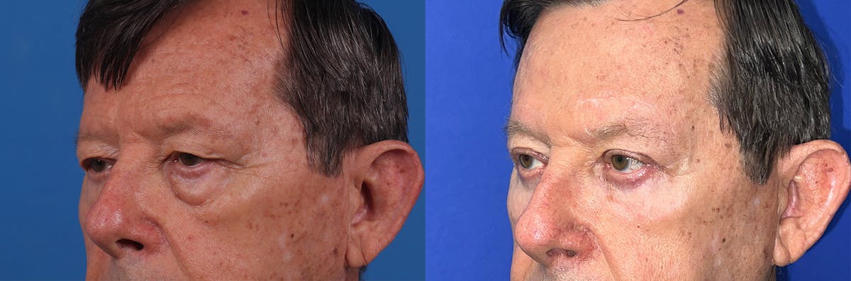 Eyelid Surgery Before & After Gallery - Patient 146900711 - Image 3