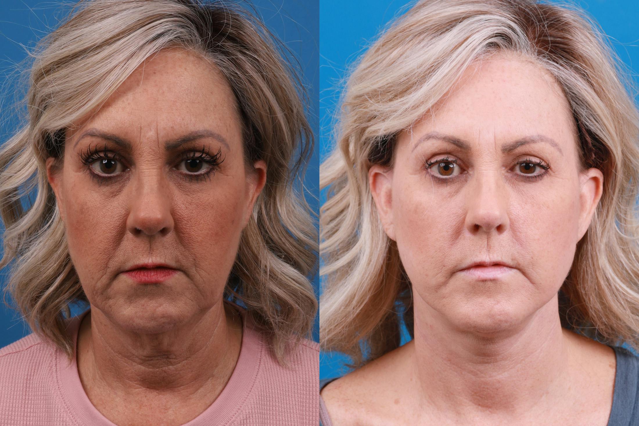 Facelift Before & After Gallery - Patient 147033236 - Image 1