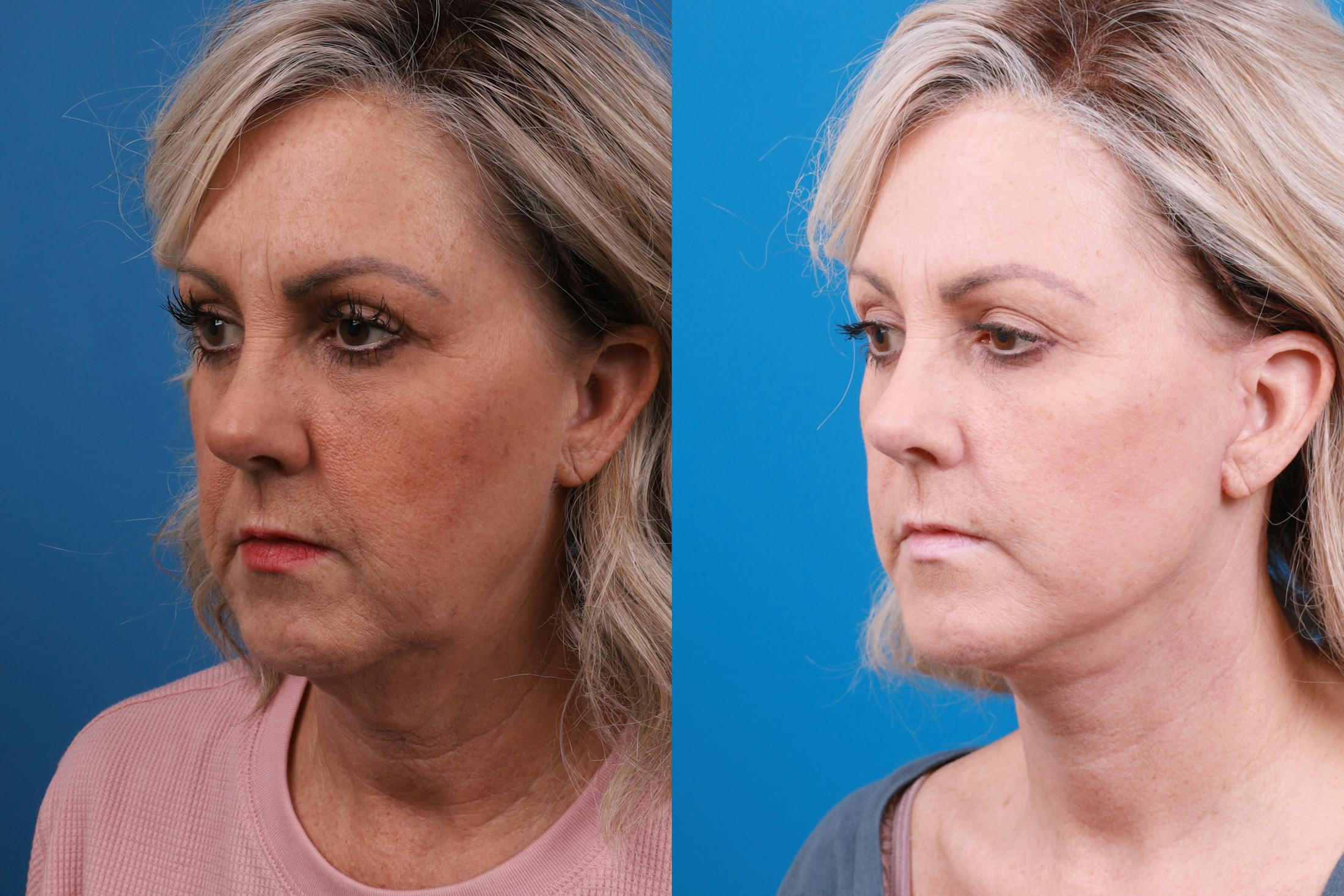 Facelift Before & After Gallery - Patient 147033236 - Image 2