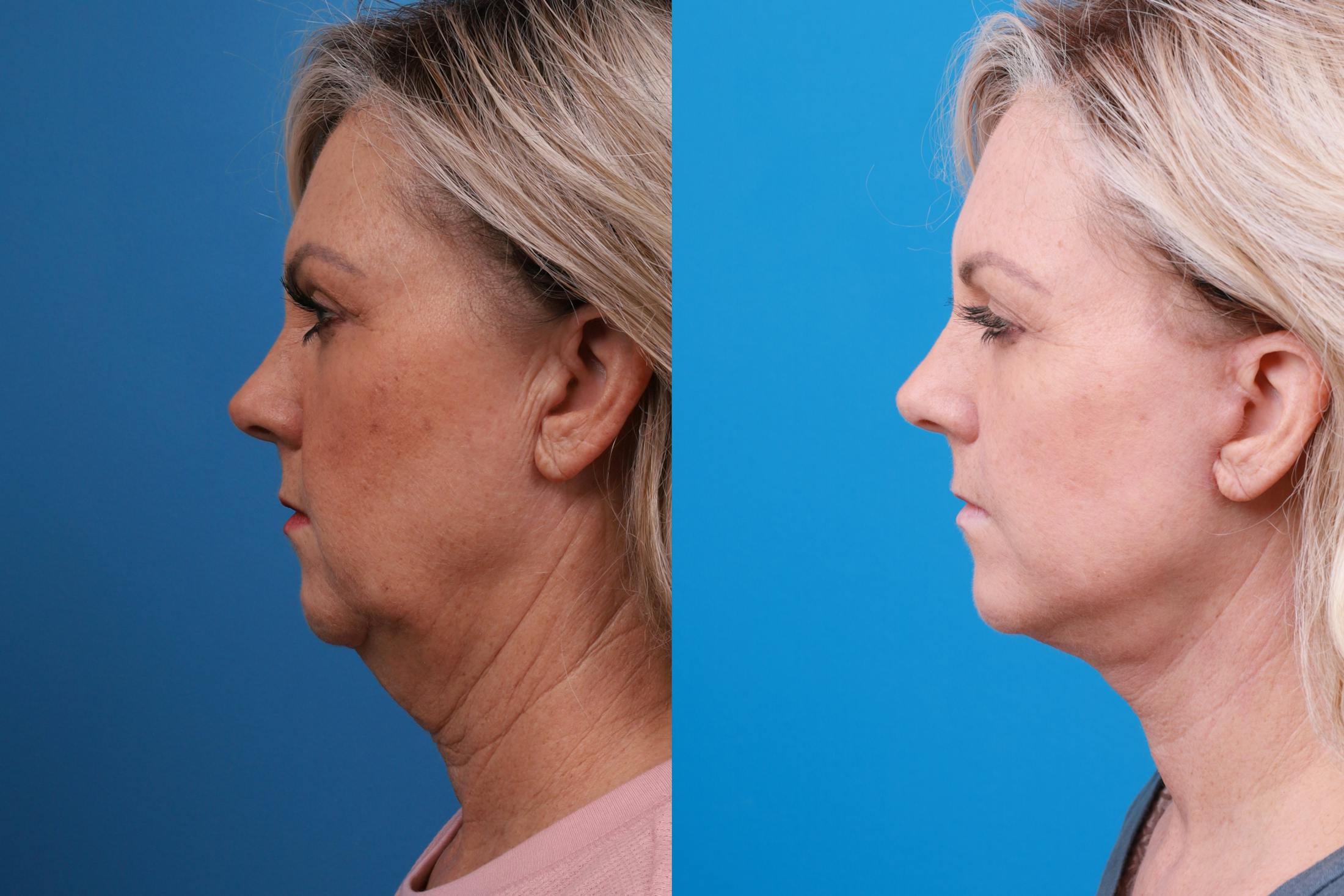 Facelift Before & After Gallery - Patient 147033236 - Image 3