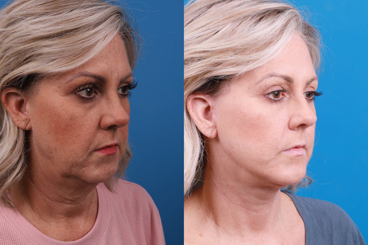 Facelift Before & After Gallery - Patient 147033236 - Image 4