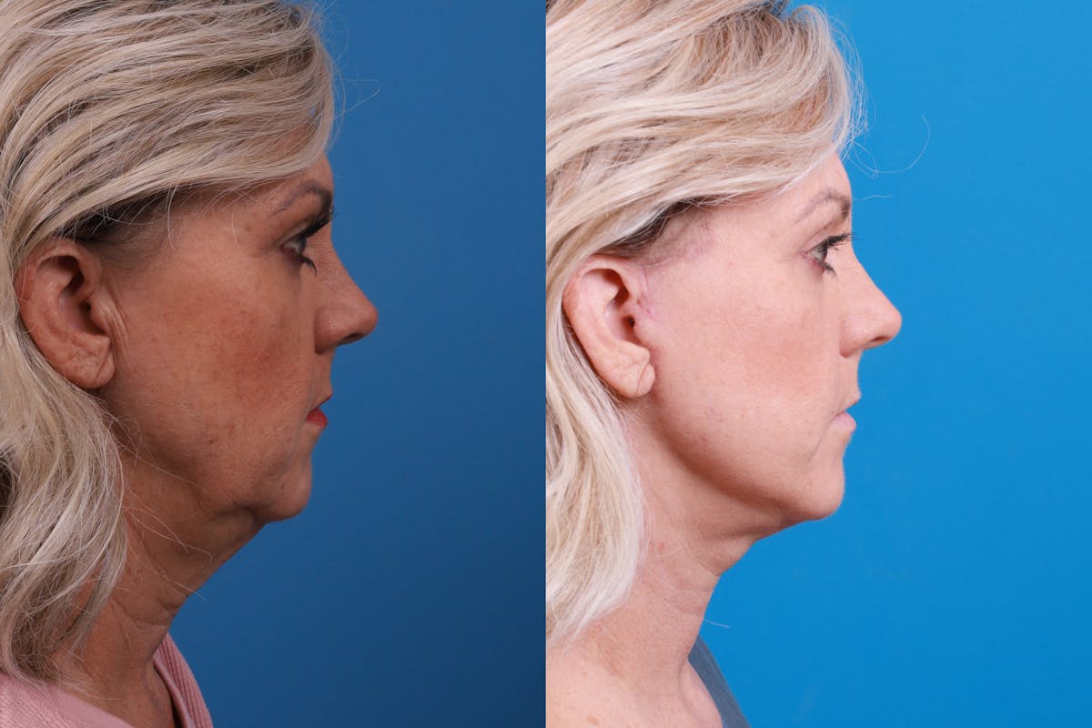 Facelift Before & After Gallery - Patient 147033236 - Image 5