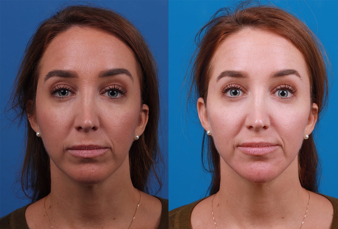 Dermal Fillers Before & After Gallery - Patient 147033474 - Image 1