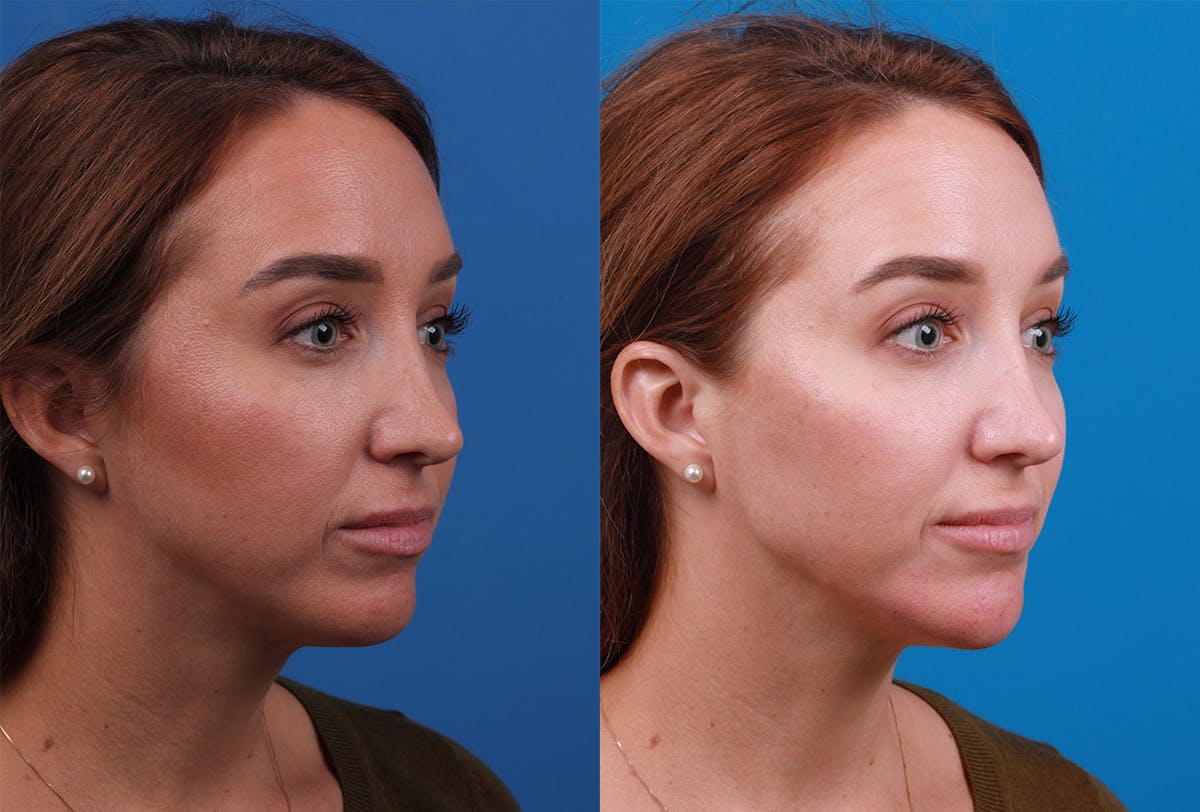 Dermal Fillers Before & After Gallery - Patient 147033474 - Image 2