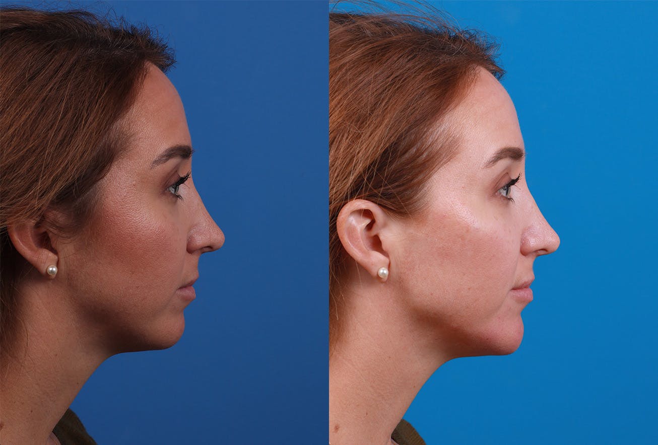 Dermal Fillers Before & After Gallery - Patient 147033474 - Image 3