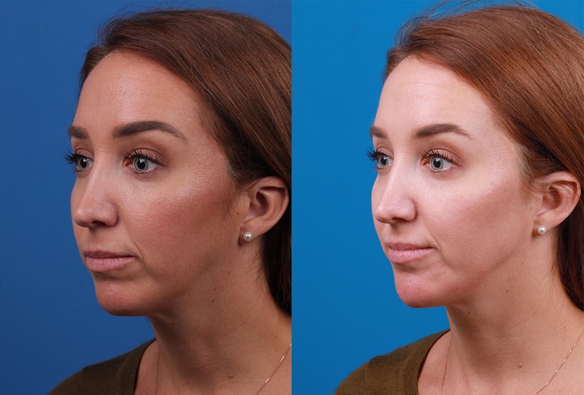 Dermal Fillers Before & After Gallery - Patient 147033474 - Image 4